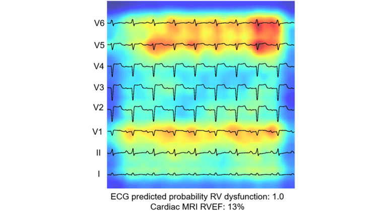 Imagen: Probabilidad de disfunción de VD predicha por ECG: 1.0 MRI cardíaca RVEF: 13 % (Fotografía cortesía de Duong, et al., Journal of the American Heart Association)